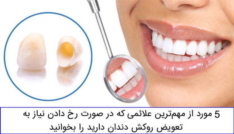 دلایل تعویض روکش دندان