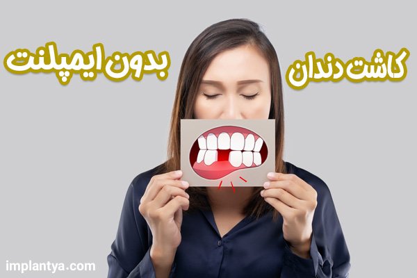 کاشت دندان بدون ایمپلنت