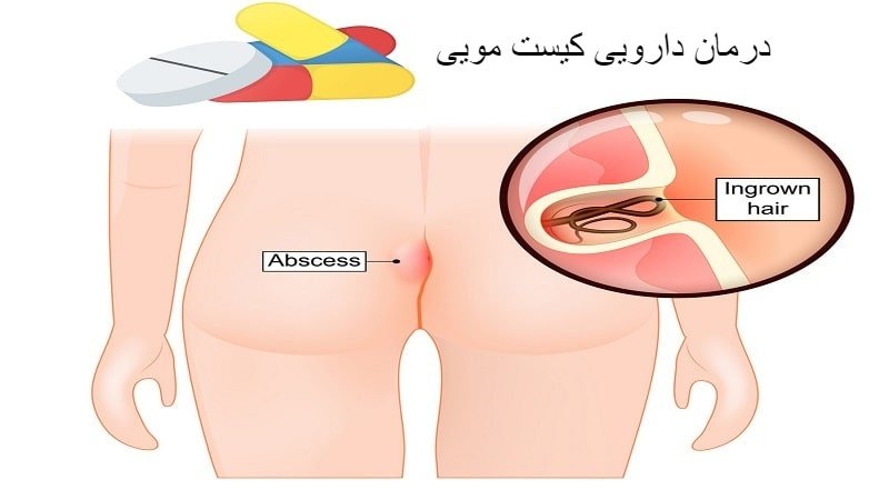 داروی کیست مویی