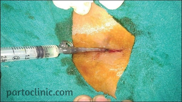 تزریق فنل برای کیست مویی