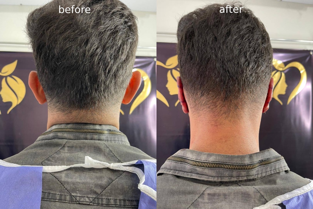 مراقبت ‌های پس از عمل اتوپلاستی