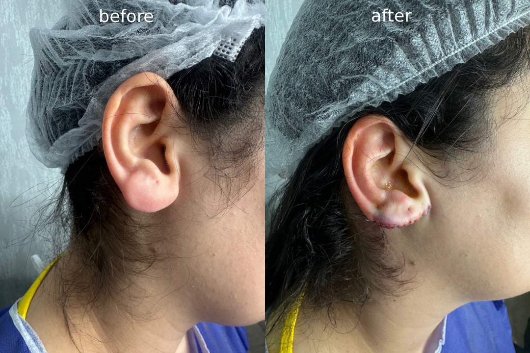 مراحل انجام عمل اتوپلاستی در کلینیک یاس