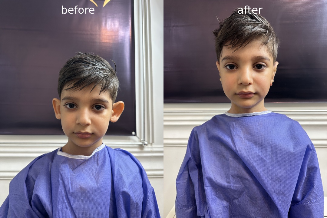 عمل اتوپلاستی چیست؟