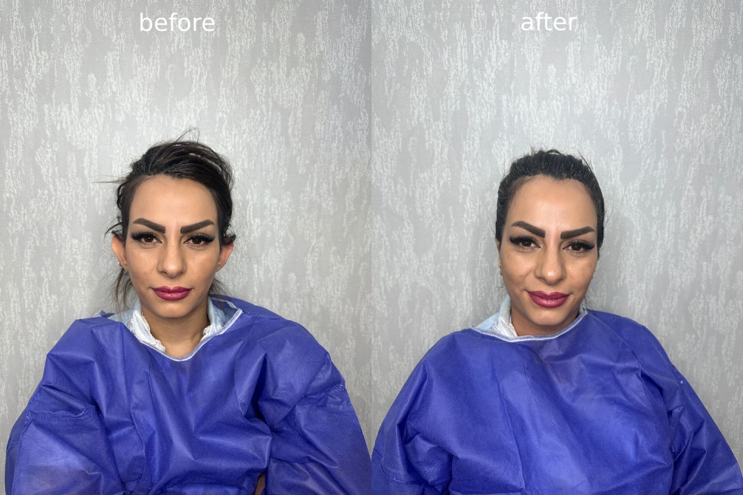 نکات مهم بعد از عمل اتوپلاستی