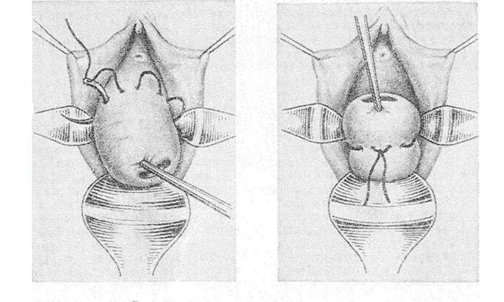 A drawing of a person's uterusAI-generated content may be incorrect.