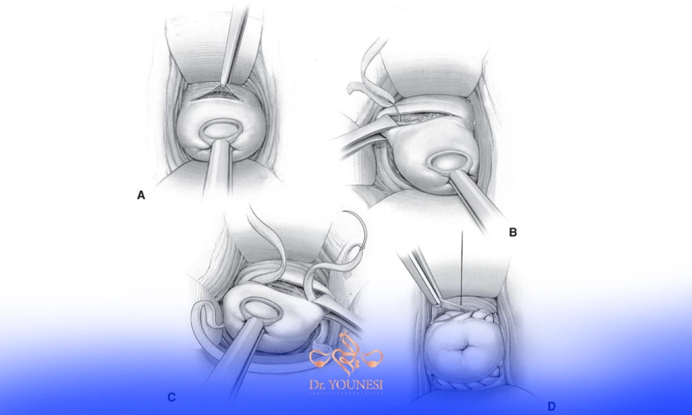A diagram of a person's uterusAI-generated content may be incorrect.